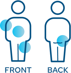 Injection sites on upper arm, stomach, upper leg, and buttocks